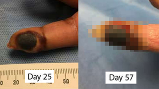Esta es la evolución de un dedo que accidentalmente se ha infectado con un virus de la viruela